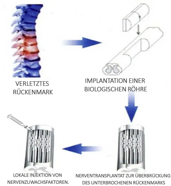 Rekonstruktion des Rückenmarks