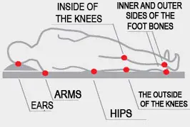 pressure ulcers