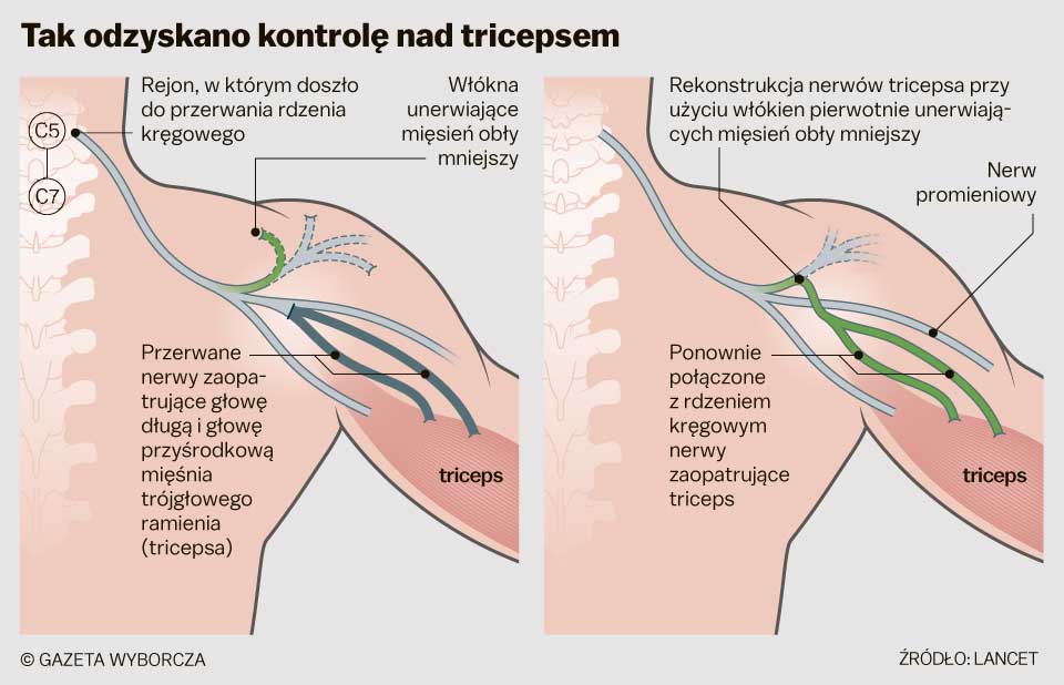 restoring hand movement