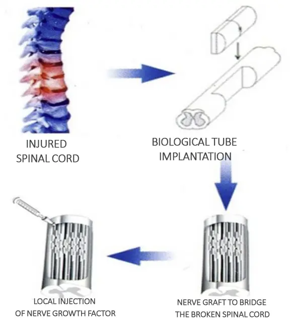 Spinal Cord Reconstruction